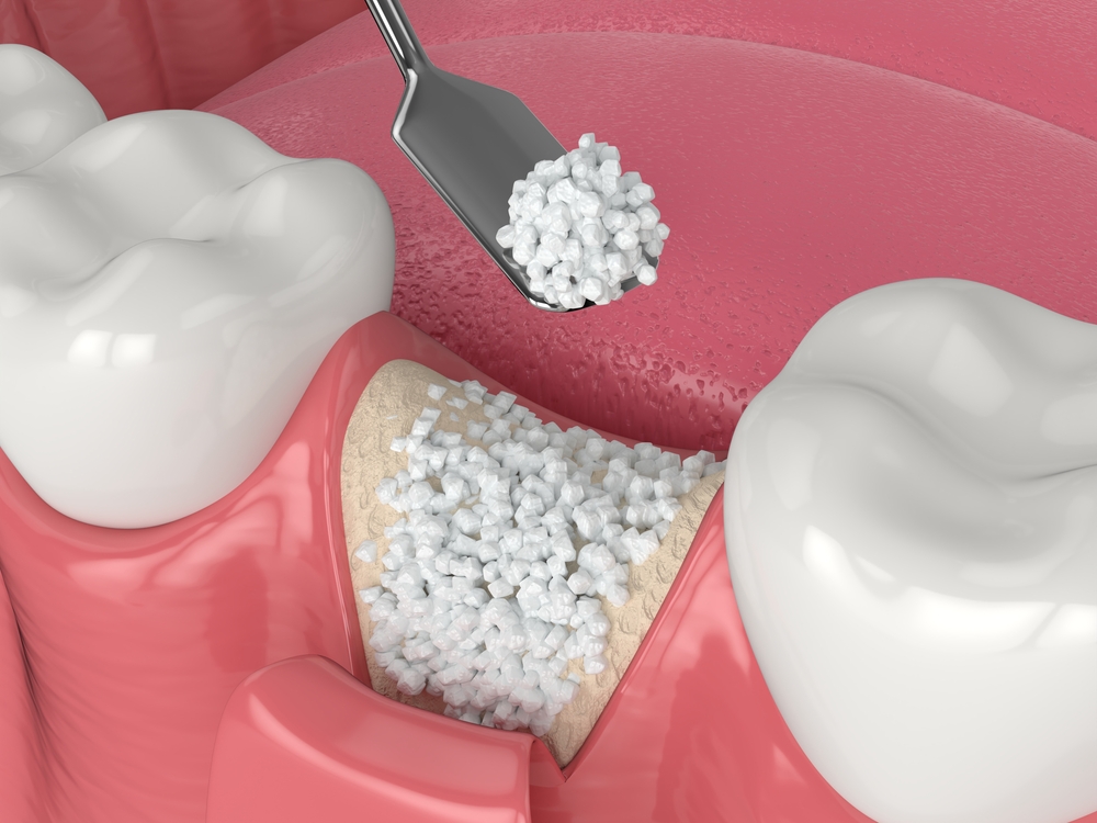 A 3D render of dental bone grafting, a procedure sometimes related to Dental Extractions and Spencer Dental in Maryville
