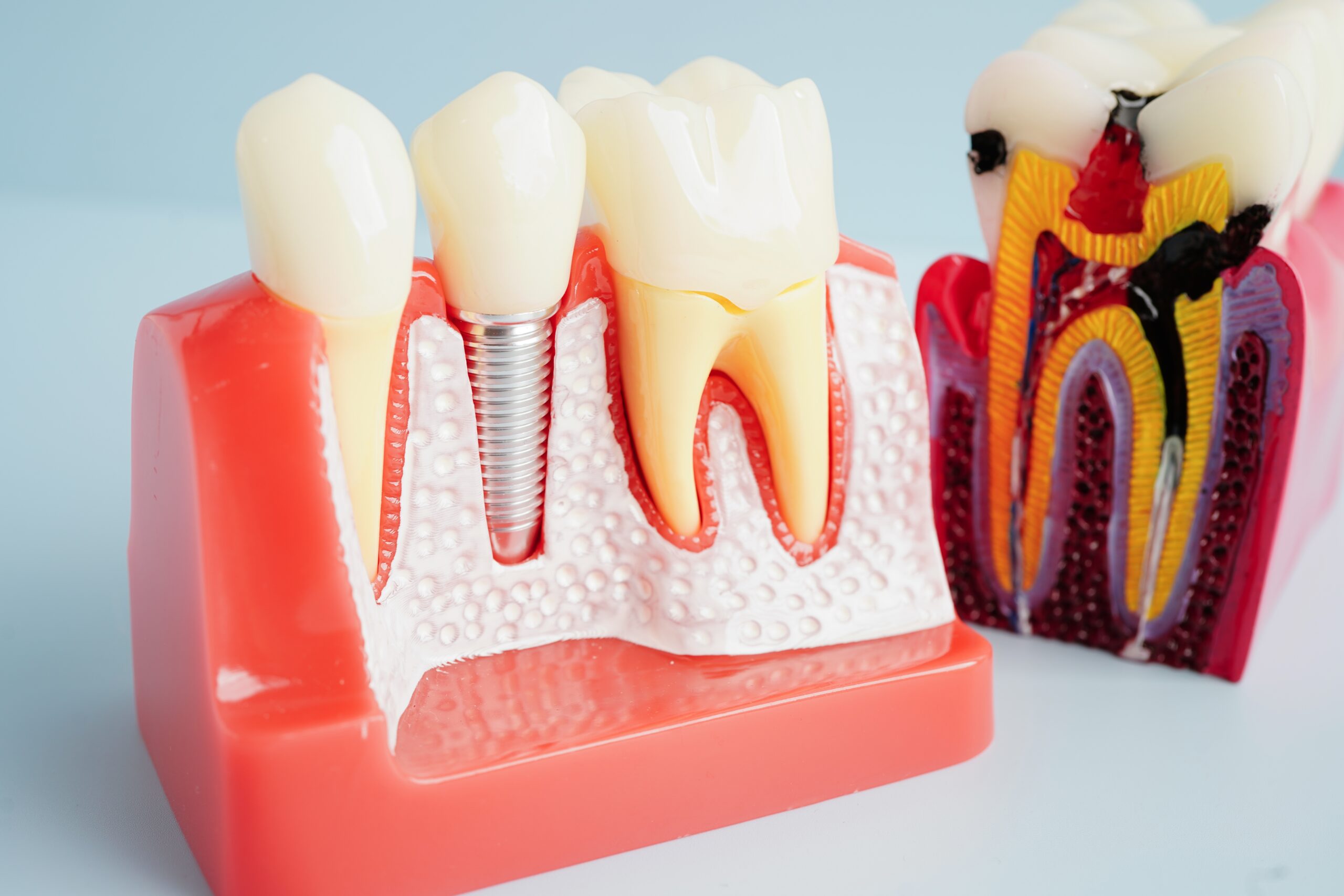 Dental Crowns in Maryville